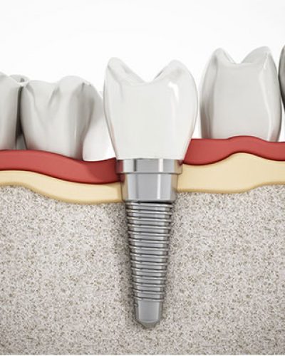 Single Dental Implant