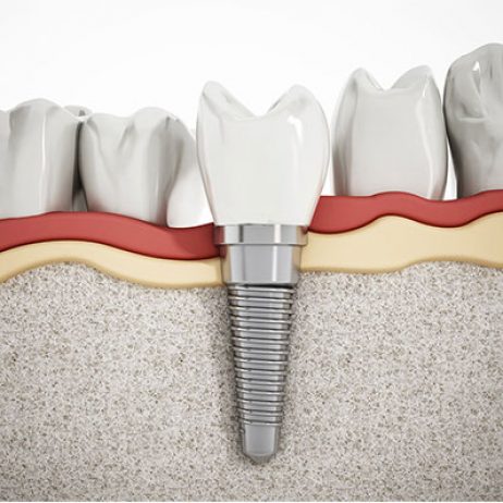 Single Dental Implant